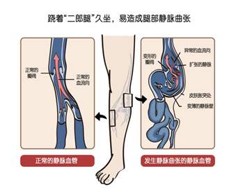 静脉曲张有哪些症状